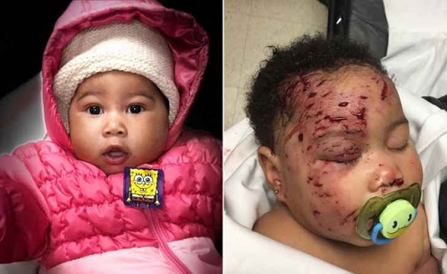 4-Month-Old Baby Girl Dragged Out Of Bed And Attacked By Raccoon