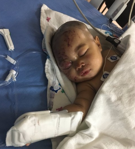 4-Month-Old Baby Girl Dragged Out Of Bed And Attacked By Raccoon