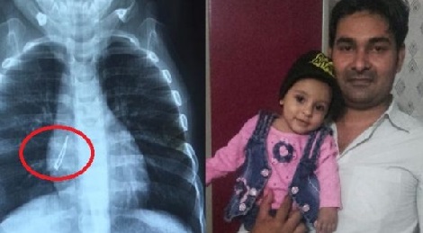 Doctors Extract LED Bulb From 7-Month-Old’s Lung [Photo]