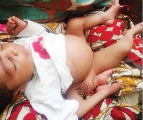 Woman Gives Birth to A Child That Has Both Sexes, 4 Legs in Katsina