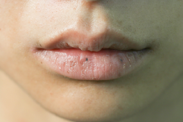 9 Things Your Lips Say About Your Health—[Tingling Lips May Signify a Stroke is coming]