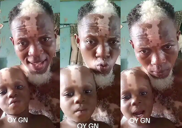 Father and son with white patches on their bodies stun many, video goes viral