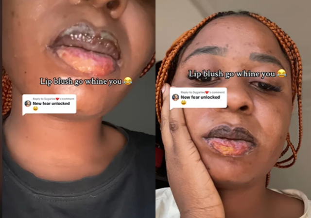 "Mine was d biggest mistake of my life" - Reactions as lady discloses damage from lip blush procedure