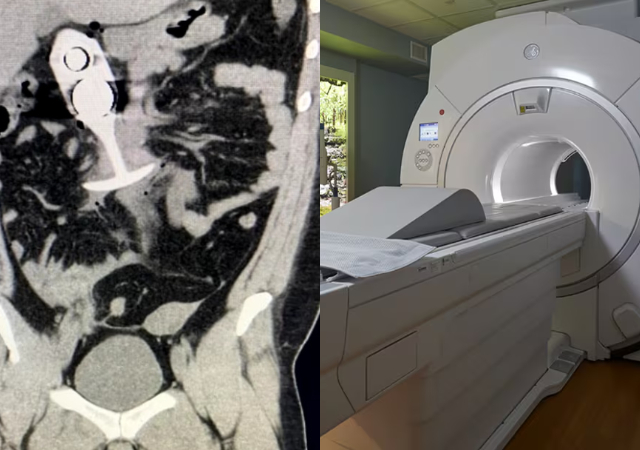 Woman sustained severe injuries after ‘mistakenly’ wearing a s3x toy to an MRI scan